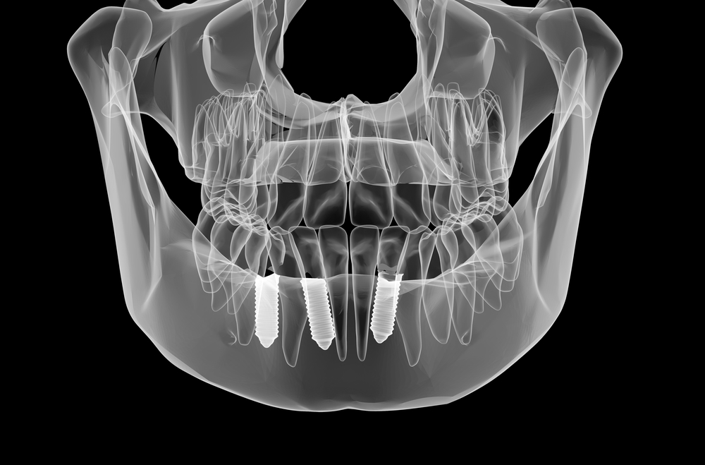 What s The Benefit Of Seeing A Dentist With A CT Scanner Fresno 